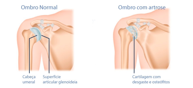 Tratamento de artrose no ombro médico ortopedista em campo grande