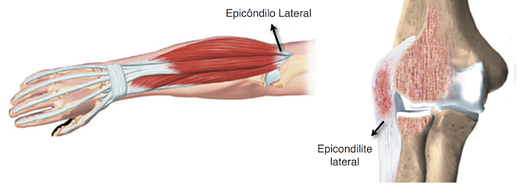 tratamento Epicondilite Lateral ou Cotovelo de Tenista