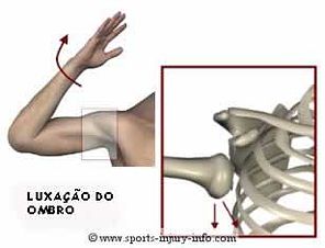 Tratamento Luxação do Ombro 