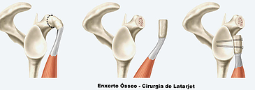 causas e tratamento da Luxação no ombro